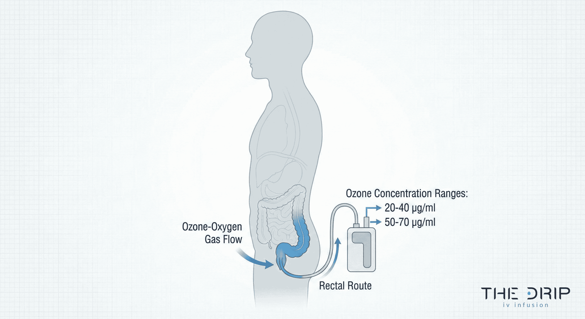 rectal-insufflation-ozone-therapy-illustration Medical illustration of ozone therapy using rectal insufflation with labeled dosage ranges.