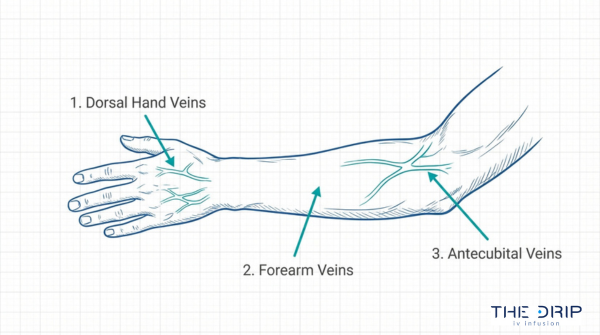 Best vein locations for IV insertion diagram showing dorsal hand veins, forearm veins, and antecubital veins