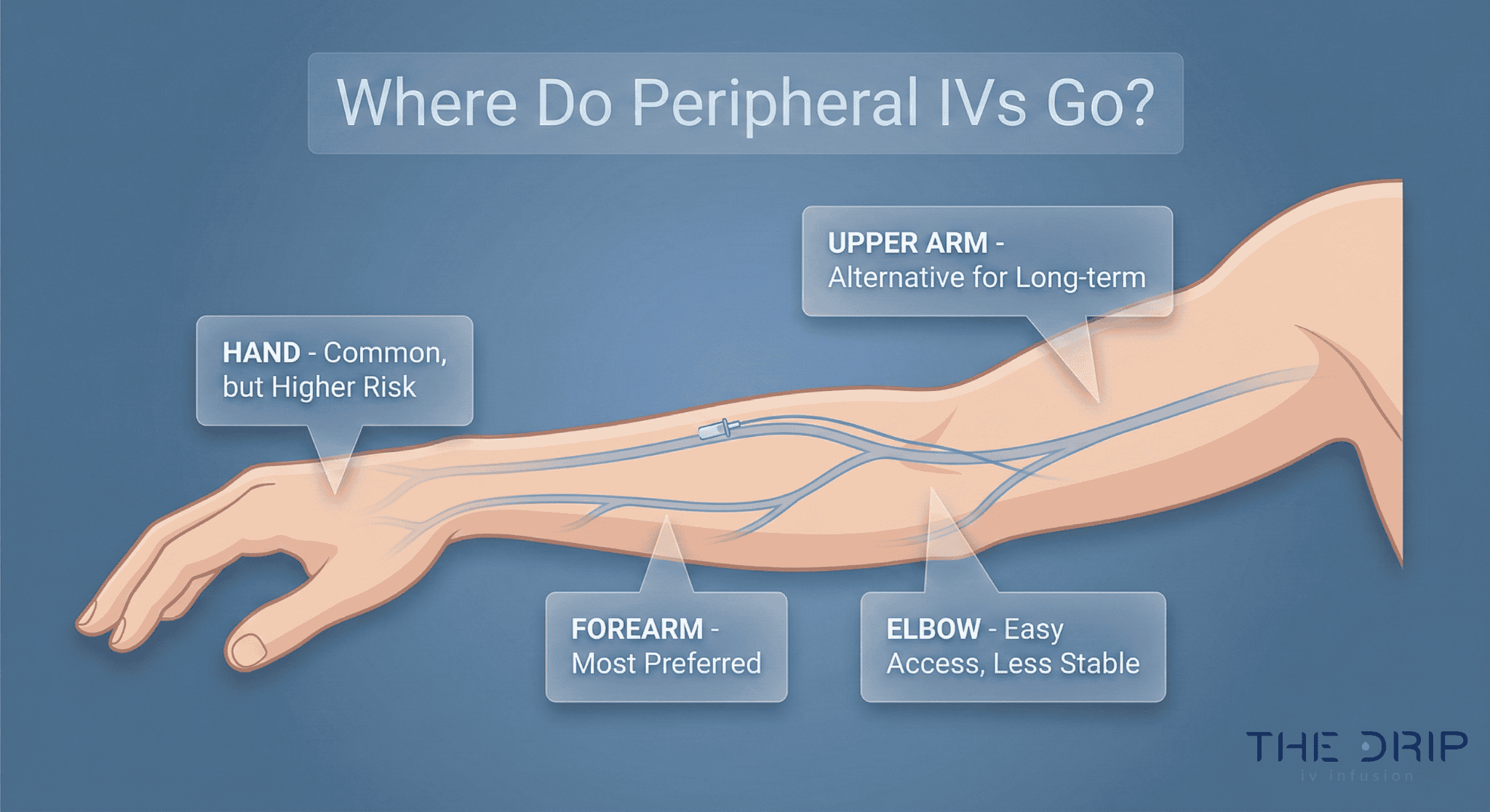 Peripheral IV Sites