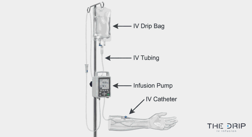 Diagram showing labeled IV therapy equipment including catheter, tubing, and pump.
